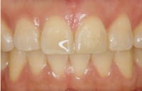 ダイレクトボンディング5