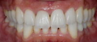 審美歯科　ラミネートベニア　症例