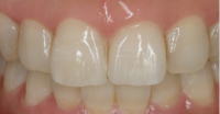 審美歯科　ラミネートベニア　症例