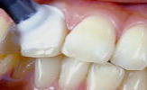 歯　クリーニング　大阪　歯面研磨画像