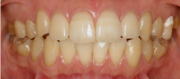 ホワイトニング 症例1