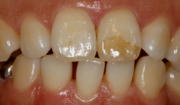 ホワイトニング 症例6