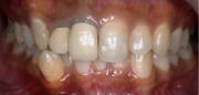 ホワイトニング 術前1