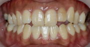 ホワイトニング 症例5