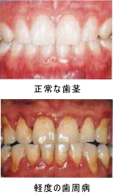正常な歯ぐきと軽度の歯周病