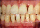 歯周病進行-3