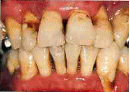 歯周病進行-4