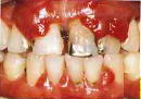 歯周病進行-5