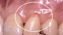 8. P.P.S (Periodontal plastic surgery)-2