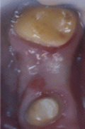 5. 欠損部歯槽堤への対応-2