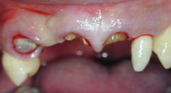 7. 歯肉縁下カリエスへの対応-1