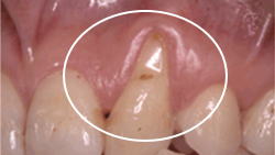 8. P.P.S (Periodontal plastic surgery)-1