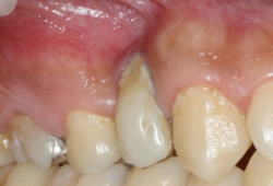 抜歯窩保護手術-1