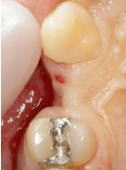 抜歯窩保護手術-2