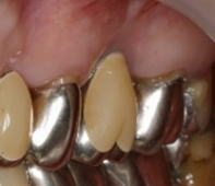 抜歯窩保護手術-3