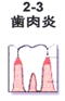 歯肉炎