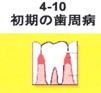 初期の歯周病