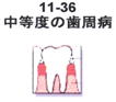 中等度の歯周病