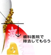 プロケア1