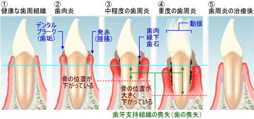 歯周病流れ