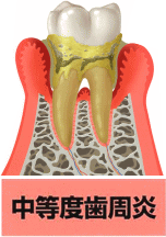 歯周病　中等度歯肉炎