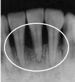 歯周病　症例画像2