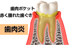 歯周病断面図