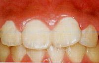 歯周病　症例1