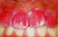 歯周病　症例2