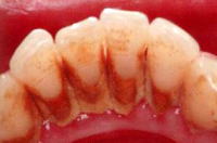 歯周病　症例3