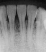 歯周病　症例画像